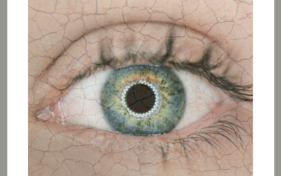 When Your Tears Don’t Work — Dry Eye Disease
