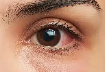Everything You Need to Know About Conjunctivitis (Pink Eye)